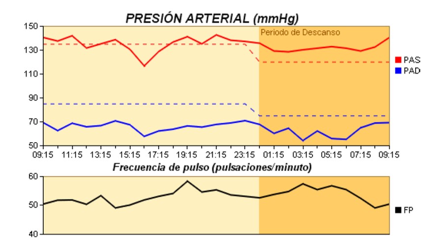 Figura 5. Variabilidad de la tensión arterial. MAPA que muestra patrón circadiano alterado (non-dipper).