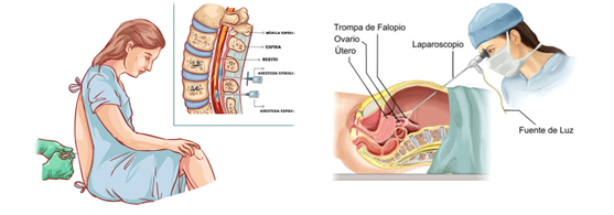 Bryonia para los síntomas después de laparoscopia y anestesia epidural