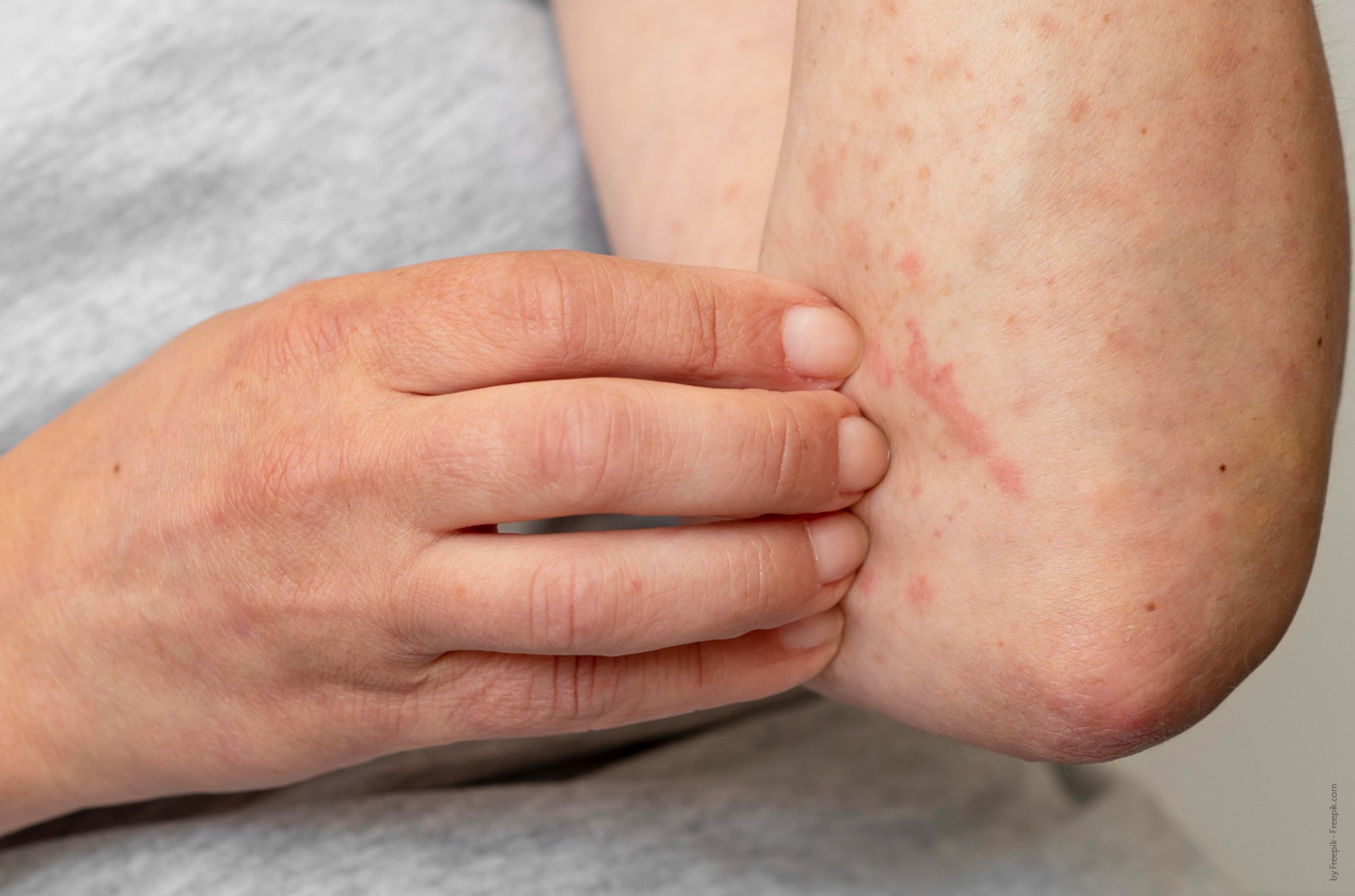 urticaria alergia persona rascándose rojez piel homeopatía