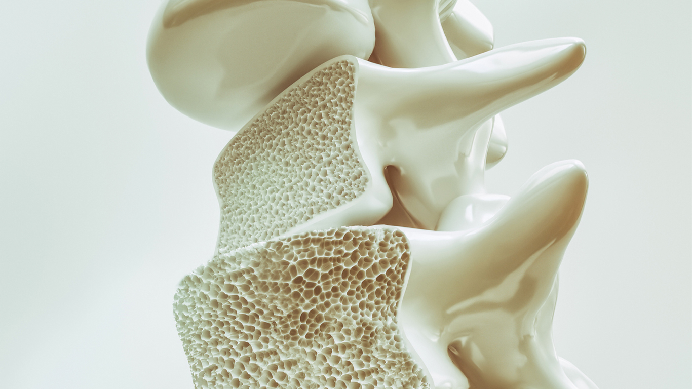 osteoporosis-homeopatia