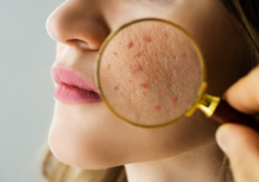 derma